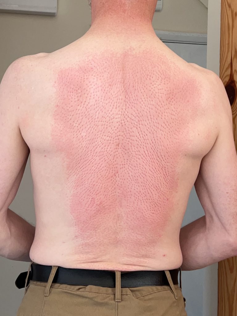 Picture of my back after 20 minutes lying on an acupressure mat